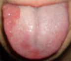Jon's Geographic Tongue Picture before