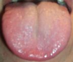 Jon's Geographic Tongue Picture after