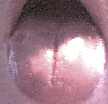 Charlene's Geographic Tongue Picture before
