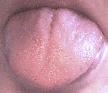 Charlene's Geographic Tongue Picture after