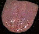 Typical Geographic Tongue