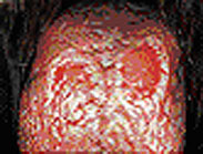 Severe Geographic Tongue