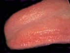 Mild Geographic Tongue